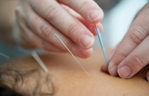 Acupuncture treatment Milton Keynes